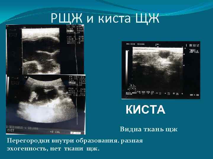 РЩЖ и киста ЩЖ КИСТА Видна ткань щж Перегородки внутри образования. разная эхогенность, нет