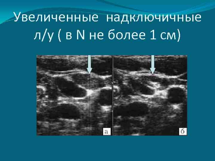 Увеличенные надключичные л/у ( в N не более 1 см) 