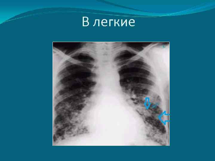 В легкие 