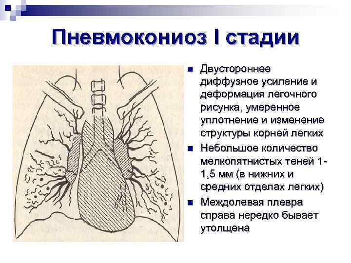 Пневмокониоз I стадии n n n Двустороннее диффузное усиление и деформация легочного рисунка, умеренное