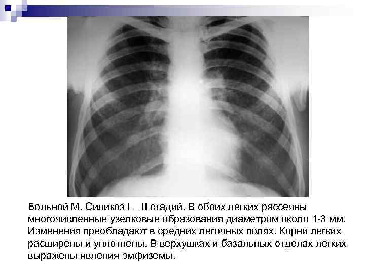 Больной М. Силикоз I – II стадий. В обоих легких рассеяны многочисленные узелковые образования