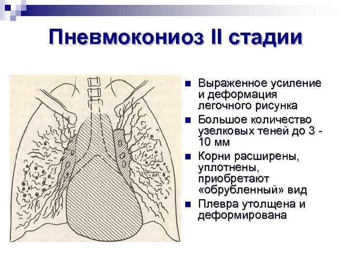 Пневмокониоз II стадии n n Выраженное усиление и деформация легочного рисунка Большое количество узелковых