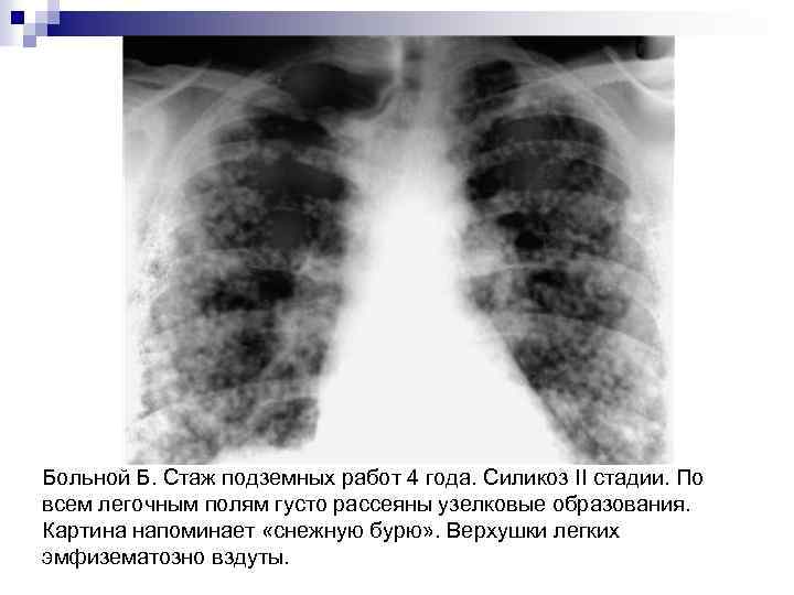 Больной Б. Стаж подземных работ 4 года. Силикоз II стадии. По всем легочным полям