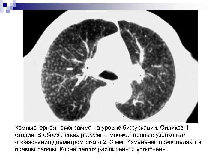 Компьютерная томограмма на уровне бифуркации. Силикоз II стадии. В обоих легких рассеяны множественные узелковые