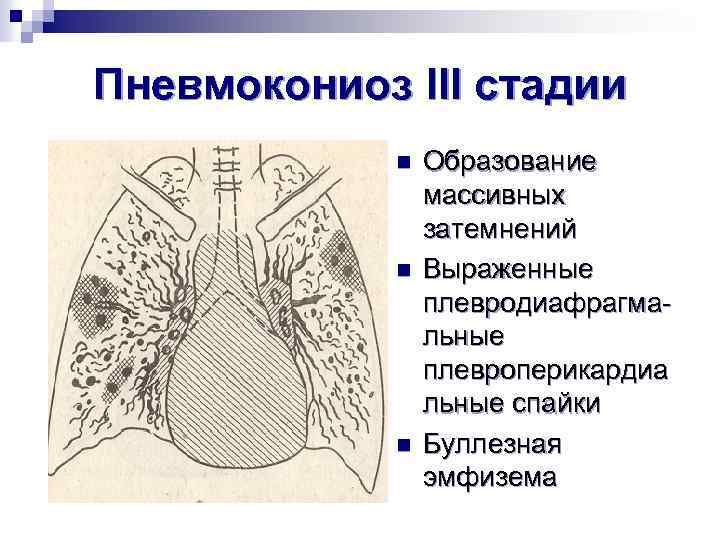 Пневмокониоз III стадии n n n Образование массивных затемнений Выраженные плевродиафрагмальные плевроперикардиа льные спайки