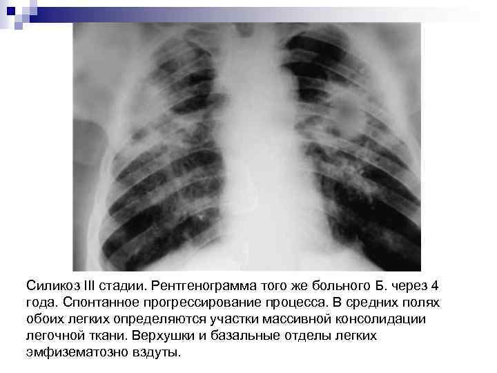 Силикоз III стадии. Рентгенограмма того же больного Б. через 4 года. Спонтанное прогрессирование процесса.