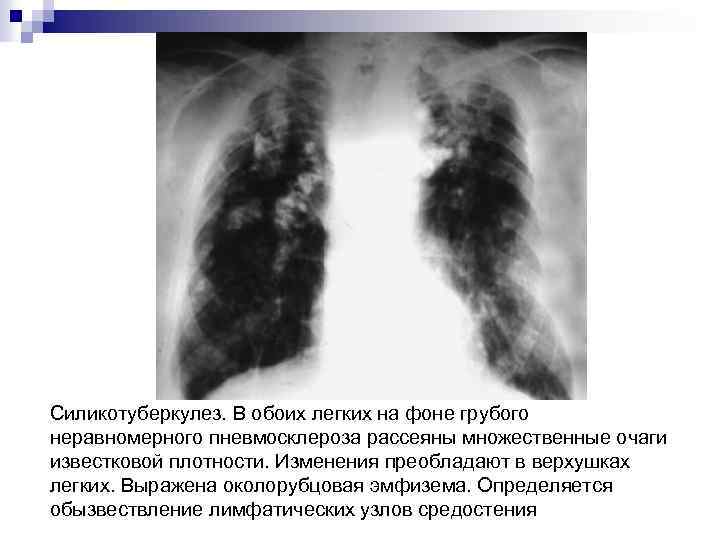 Силикотуберкулез. В обоих легких на фоне грубого неравномерного пневмосклероза рассеяны множественные очаги известковой плотности.