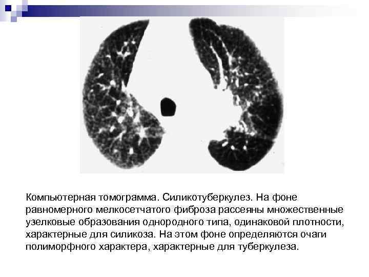 Компьютерная томограмма. Силикотуберкулез. На фоне равномерного мелкосетчатого фиброза рассеяны множественные узелковые образования однородного типа,