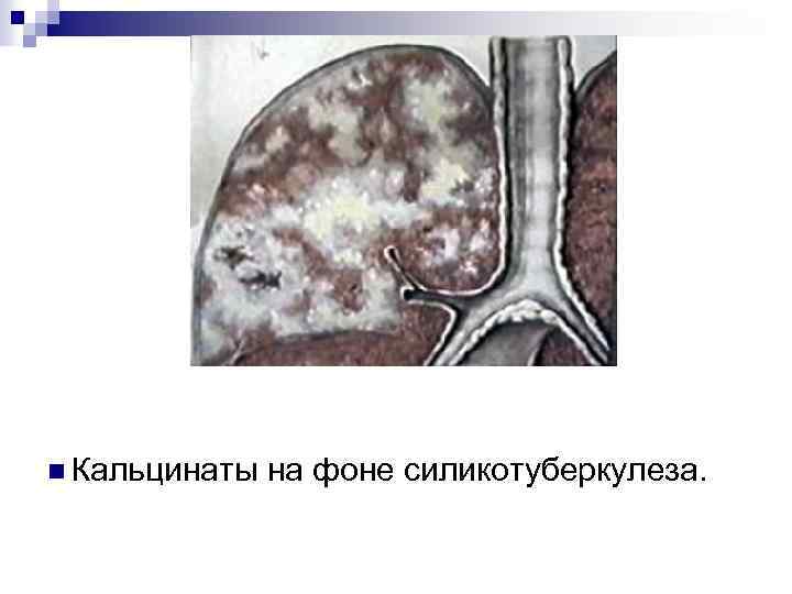 n Кальцинаты на фоне силикотуберкулеза. 