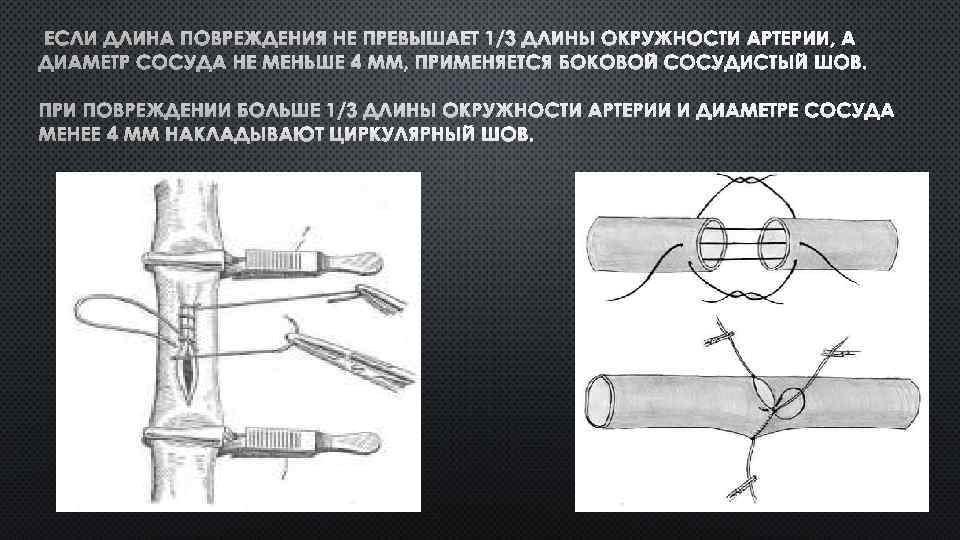 ЕСЛИ ДЛИНА ПОВРЕЖДЕНИЯ НЕ ПРЕВЫШАЕТ 1/3 ДЛИНЫ ОКРУЖНОСТИ АРТЕРИИ, А ДИАМЕТР СОСУДА НЕ МЕНЬШЕ