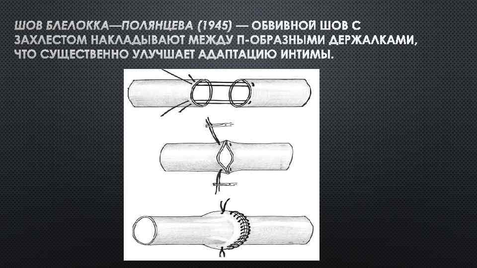 ШОВ БЛЕЛОККА—ПОЛЯНЦЕВА (1945) — ОБВИВНОЙ ШОВ С ЗАХЛЕСТОМ НАКЛАДЫВАЮТ МЕЖДУ П-ОБРАЗНЫМИ ДЕРЖАЛКАМИ, ЧТО СУЩЕСТВЕННО