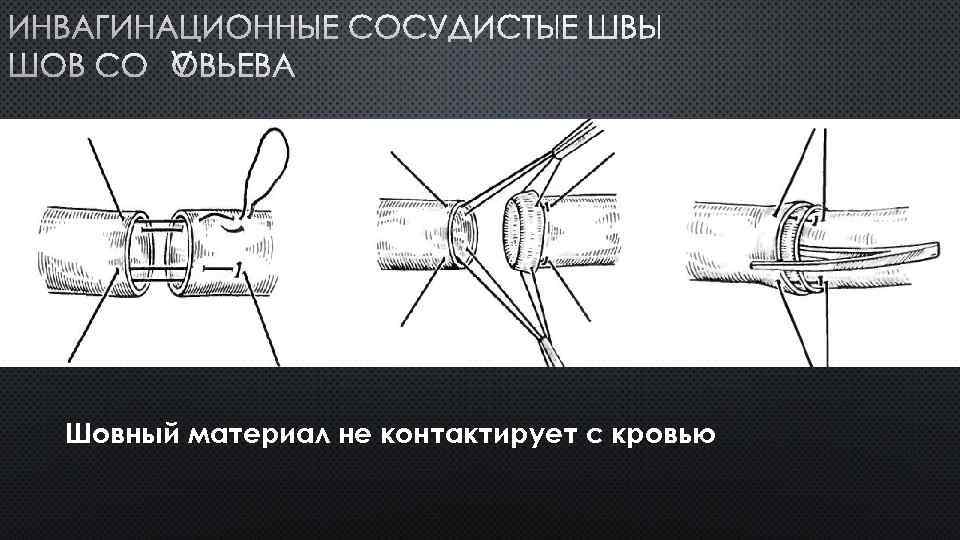 ИНВАГИНАЦИОННЫЕ СОСУДИСТЫЕ ШВЫ ШОВ СОЛОВЬЕВА Шовный материал не контактирует с кровью 