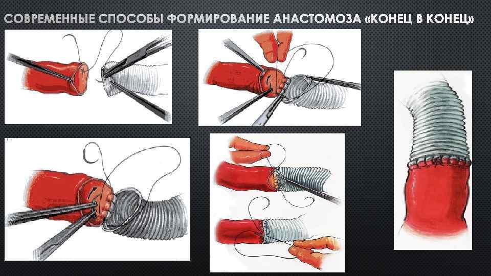 СОВРЕМЕННЫЕ СПОСОБЫ ФОРМИРОВАНИЕ АНАСТОМОЗА «КОНЕЦ В КОНЕЦ» 