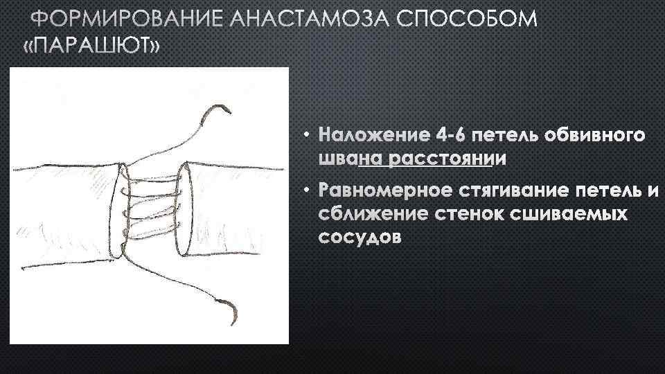 ФОРМИРОВАНИЕ АНАСТАМОЗА СПОСОБОМ «ПАРАШЮТ» • НАЛОЖЕНИЕ 4 -6 ПЕТЕЛЬ ОБВИВНОГО ШВА НА РАССТОЯНИИ •