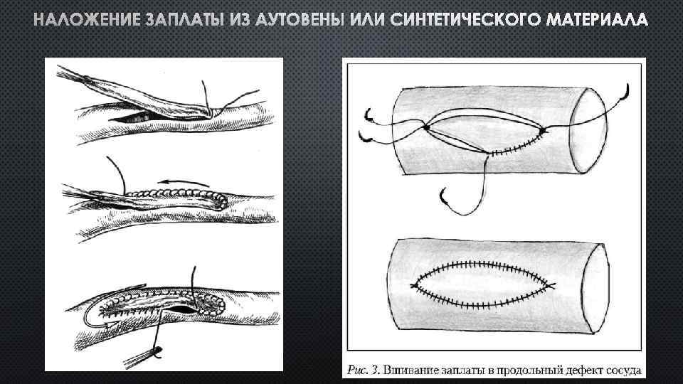 НАЛОЖЕНИЕ ЗАПЛАТЫ ИЗ АУТОВЕНЫ ИЛИ СИНТЕТИЧЕСКОГО МАТЕРИАЛА 