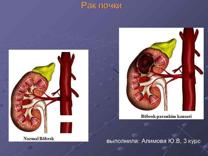 Рак почки выполнила: Алимова Ю. В, 3 курс 