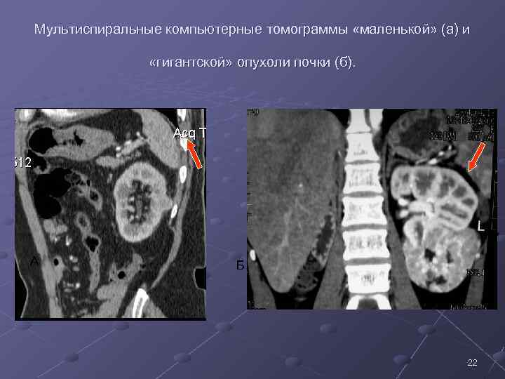 Мультиспиральные компьютерные томограммы «маленькой» (а) и «гигантской» опухоли почки (б). А Б 22 