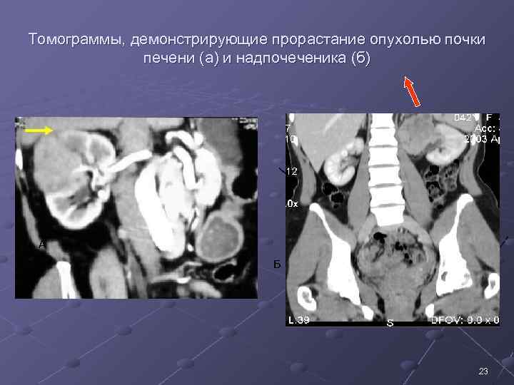 Томограммы, демонстрирующие прорастание опухолью почки печени (а) и надпочеченика (б) А Б 23 