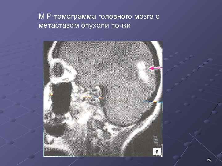 М Р томограмма головного мозга с метастазом опухоли почки 24 