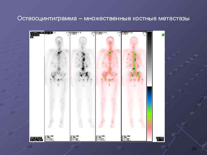 Остеосцинтиграмма – множественные костные метастазы 26 