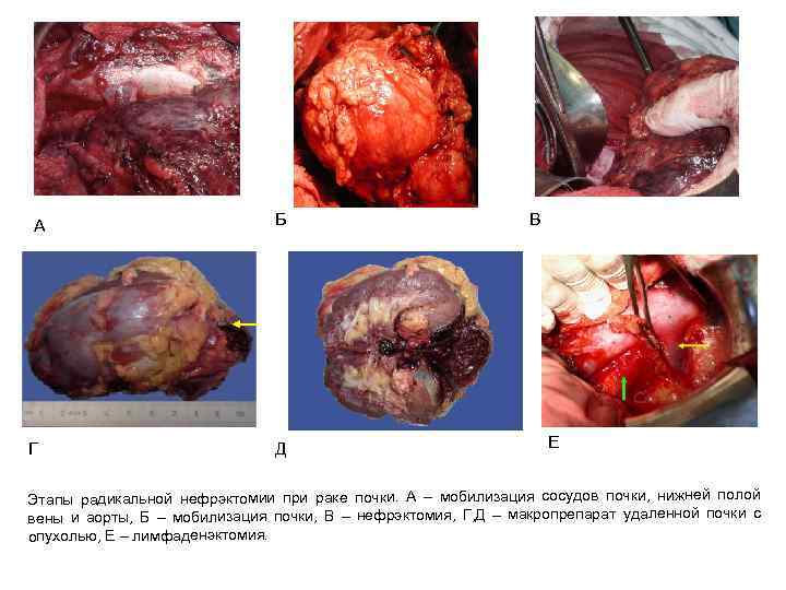 А Г Б Д В Е Этапы радикальной нефрэктомии при раке почки. А –