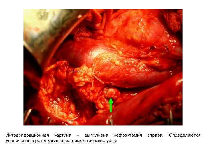 Интраоперационная картина – выполнена нефрэктомия увеличенные ретрокавальные лимфатические узлы справа. Определяются 
