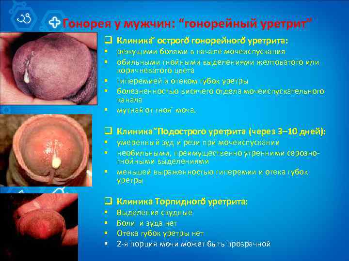 Гонорея у мужчин: “гонорейный уретрит” q Клиника острого гонореи ного уретрита: § § §