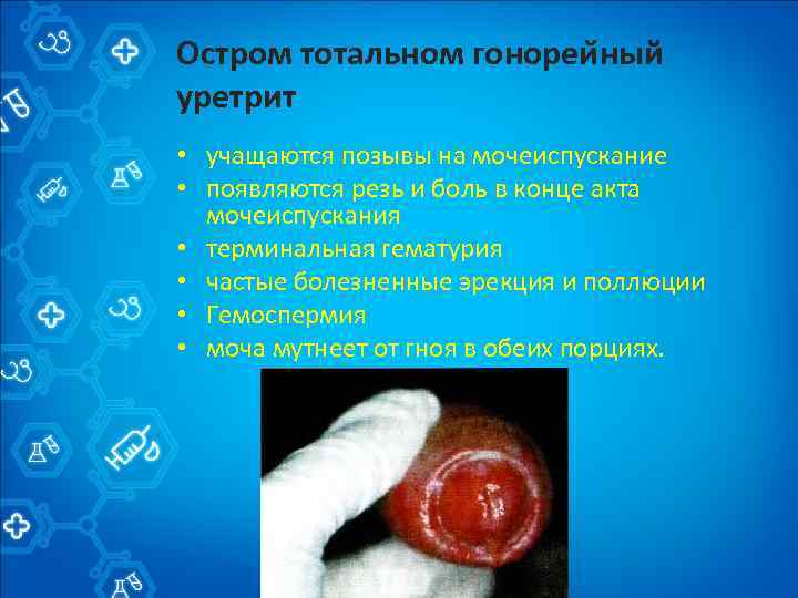 Остром тотальном гонореи ный уретрит • учащаются позывы на мочеиспускание • появляются резь и