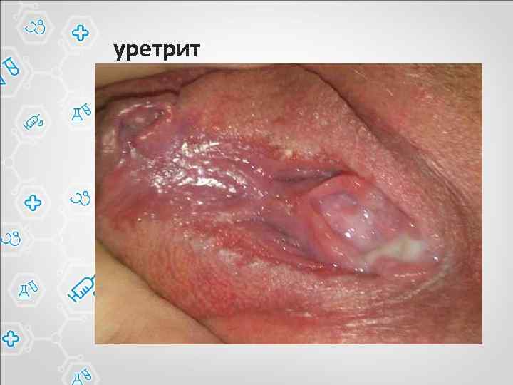 уретрит 