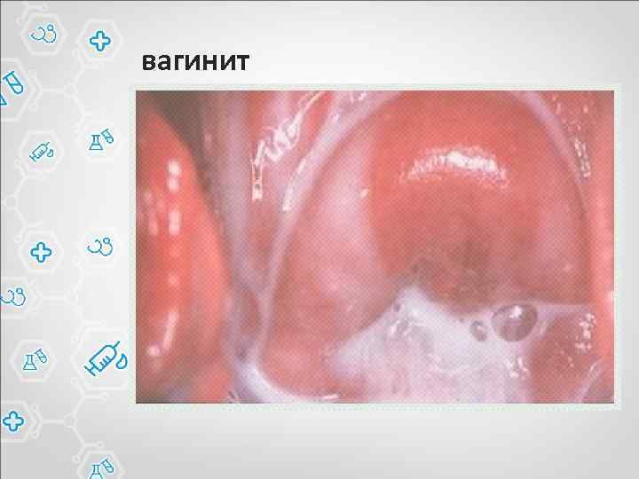 вагинит 