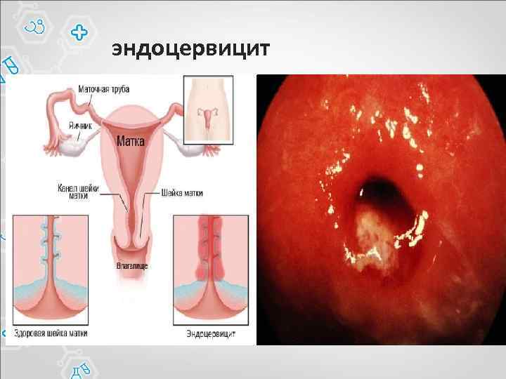 эндоцервицит 
