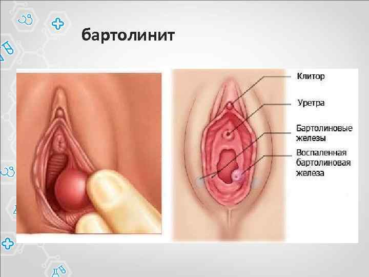 бартолинит 