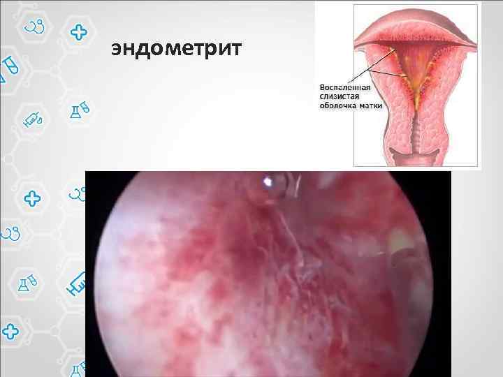 эндометрит 