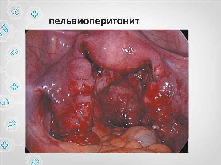 пельвиоперитонит 