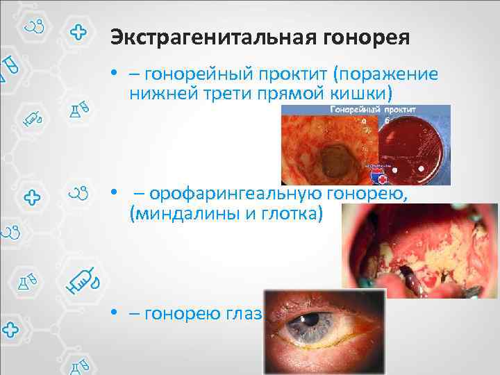 Экстрагенитальная гонорея • – гонореи ныи проктит (поражение нижнеи трети прямои кишки) • –