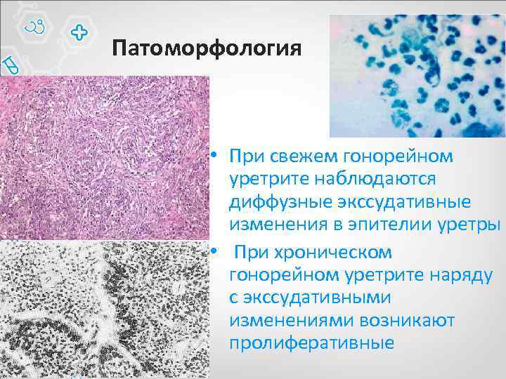 Патоморфология • При свежем гонореи ном уретрите наблюдаются диффузные экссудативные изменения в эпителии уретры