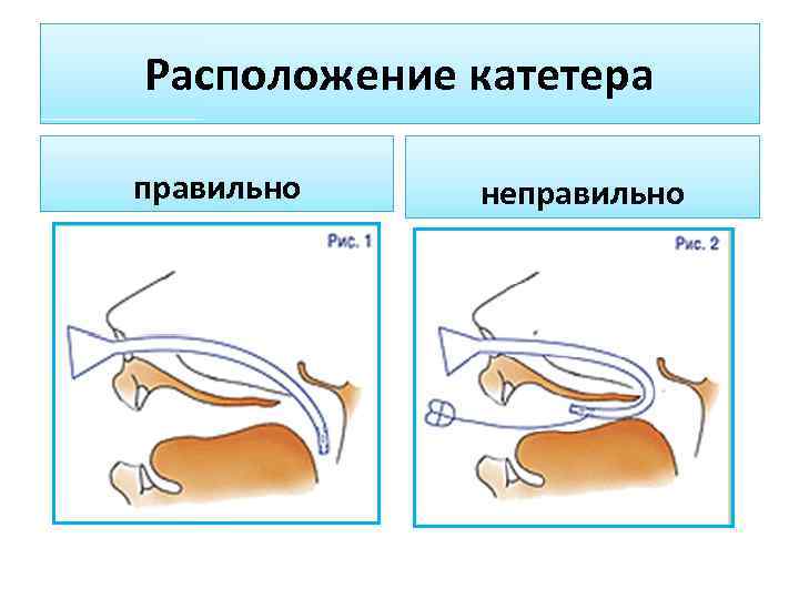 Расположение катетера правильно неправильно 