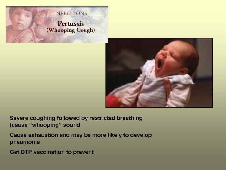 Severe coughing followed by restricted breathing (cause “whooping” sound Cause exhaustion and may be