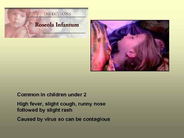 Common in children under 2 High fever, slight cough, runny nose followed by slight