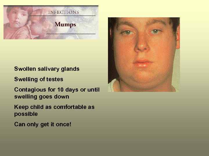 Swollen salivary glands Swelling of testes Contagious for 10 days or until swelling goes