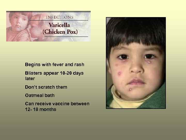 Begins with fever and rash Blisters appear 10 -20 days later Don’t scratch them