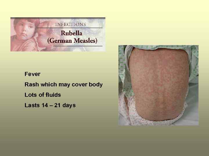 Fever Rash which may cover body Lots of fluids Lasts 14 – 21 days