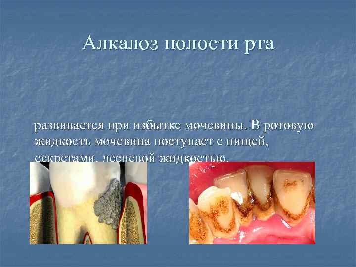 Алкалоз полости рта развивается при избытке мочевины. В ротовую жидкость мочевина поступает с пищей,