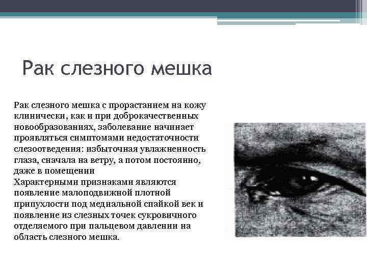 Рак слезного мешка с прорастанием на кожу клинически, как и при доброкачественных новообразованиях, заболевание