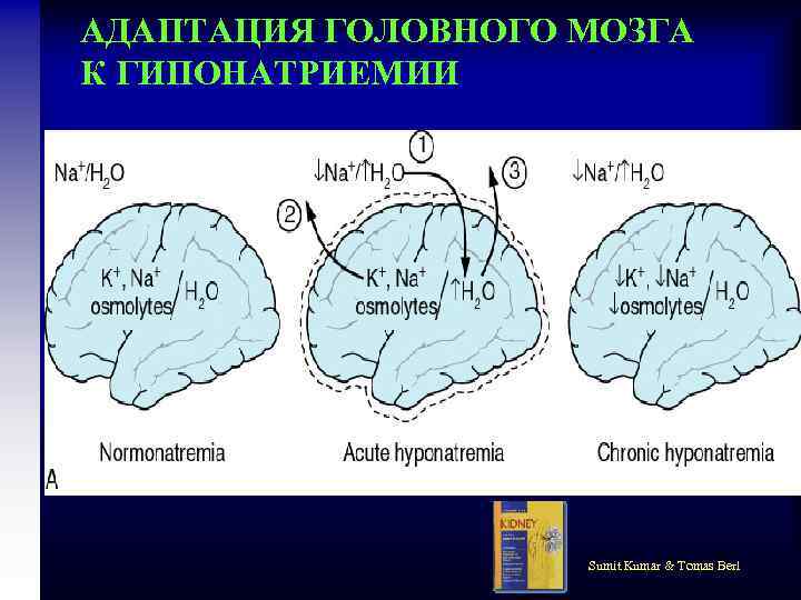АДАПТАЦИЯ ГОЛОВНОГО МОЗГА К ГИПОНАТРИЕМИИ Sumit Kumar & Tomas Berl 