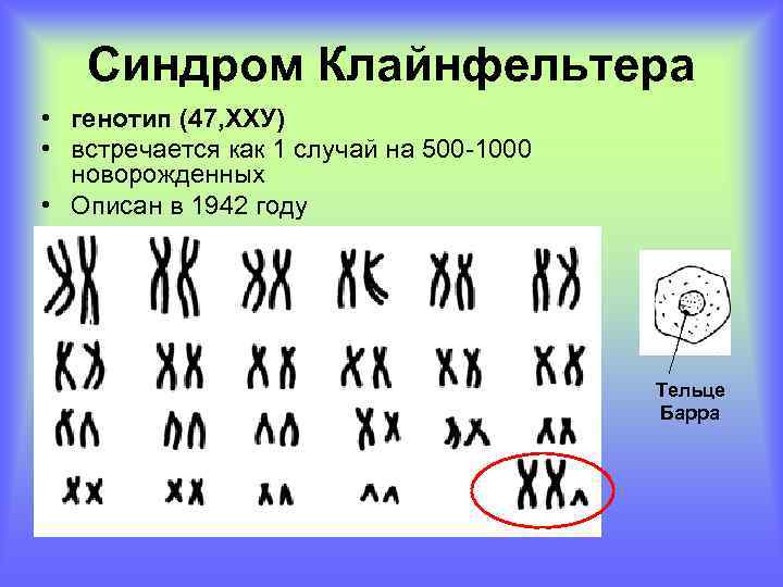 Синдром Клайнфельтера • генотип (47, ХХУ) • встречается как 1 случай на 500 -1000