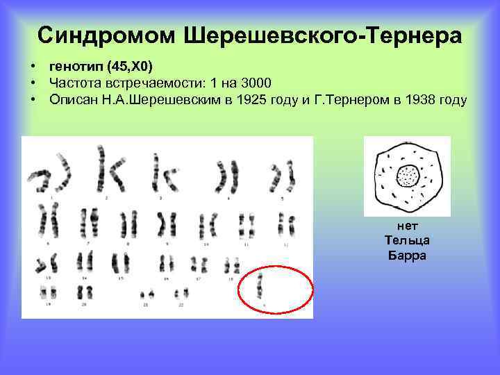 Синдромом Шерешевского-Тернера • генотип (45, Х 0) • Частота встречаемости: 1 на 3000 •