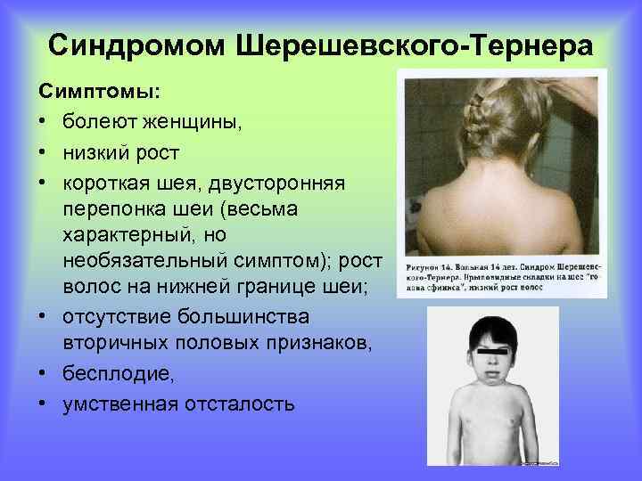 Синдромом Шерешевского-Тернера Симптомы: • болеют женщины, • низкий рост • короткая шея, двусторонняя перепонка