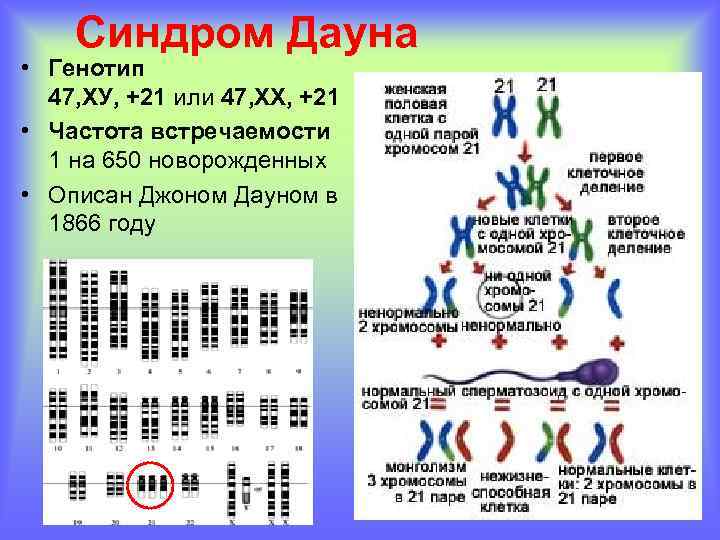 Синдром Дауна • Генотип 47, ХУ, +21 или 47, ХХ, +21 • Частота встречаемости