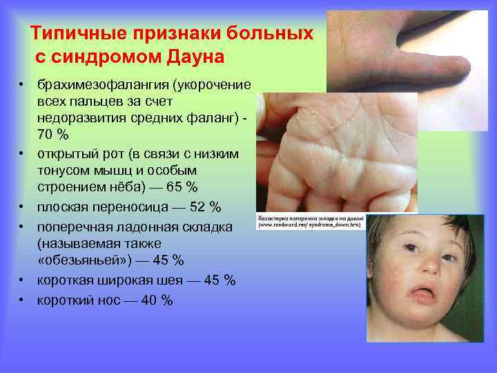 Типичные признаки больных с синдромом Дауна • брахимезофалангия (укорочение всех пальцев за счет недоразвития